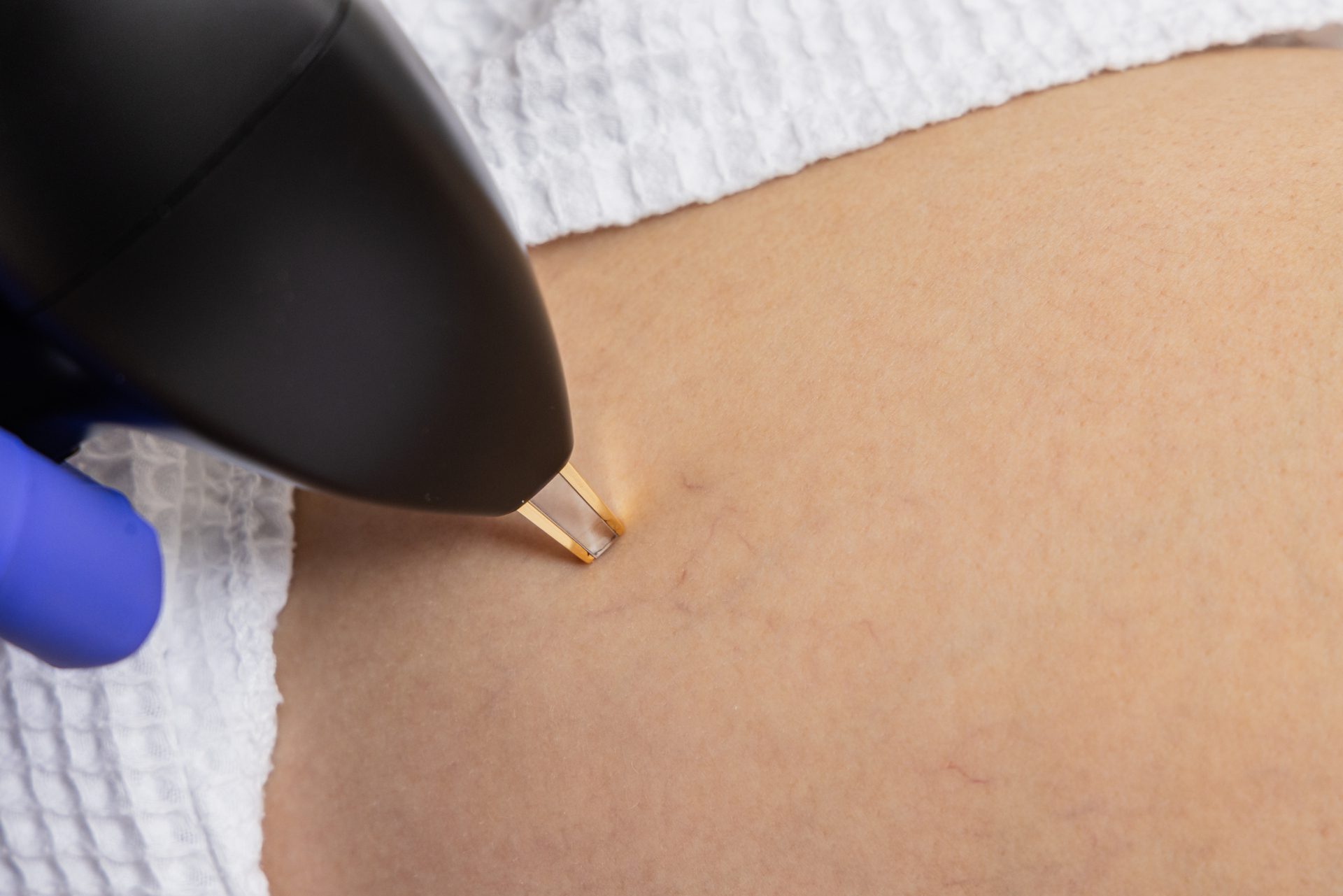 Vasculaze – Laser vasculaire