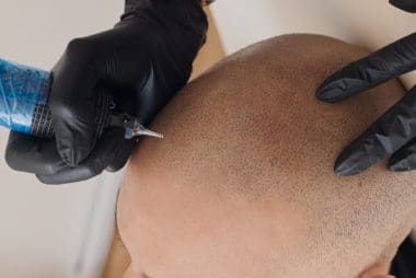 Micropigmentation capillaire : tatouage pour cuir chevelu