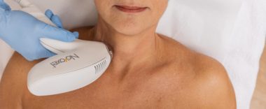 Tixel : solution non invasive pour tonifier le contour des yeux
