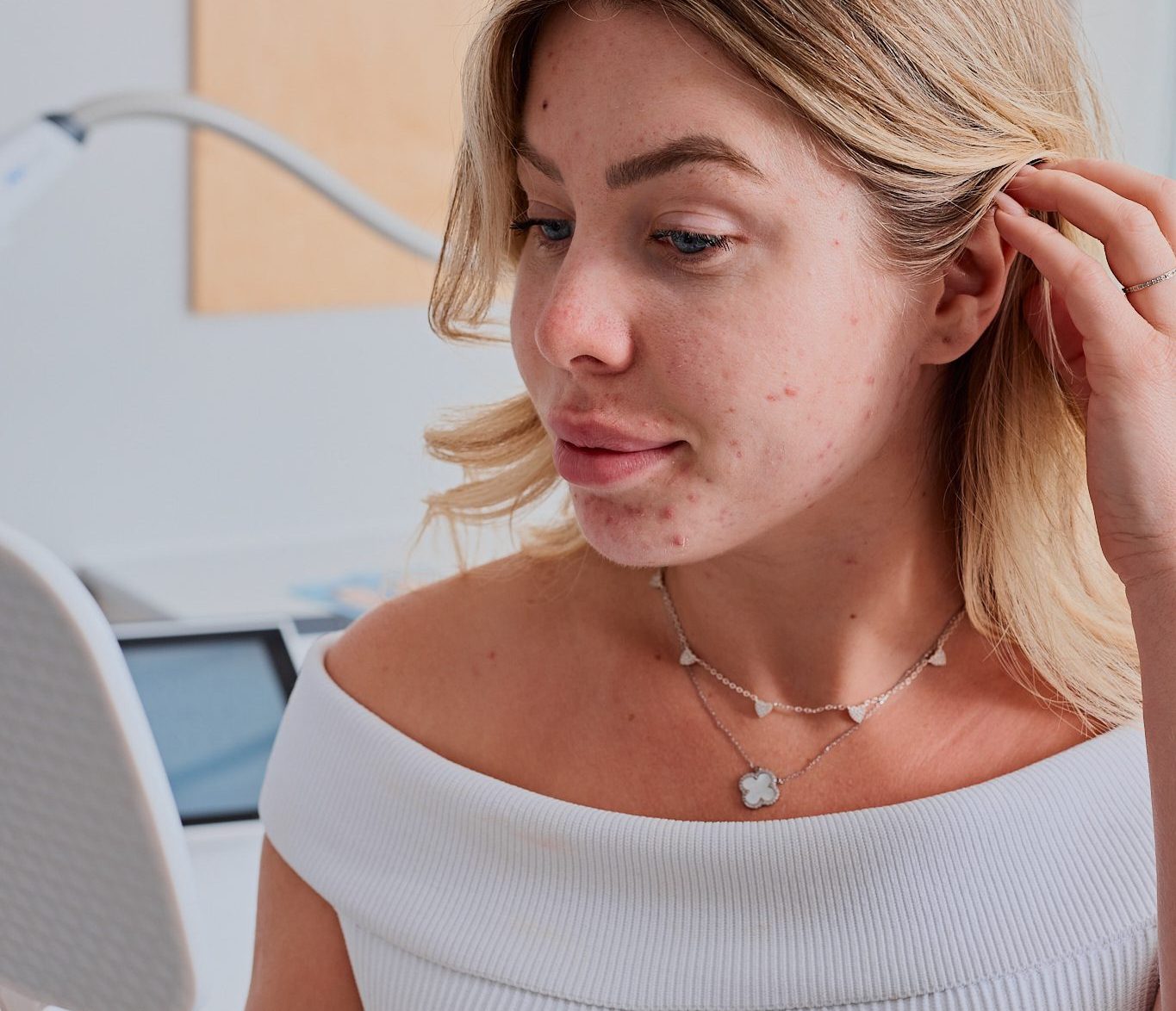 Acné : boutons et inflammations visibles