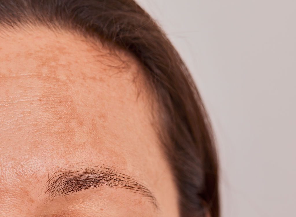 Mélasma : taches brunes sur la peau