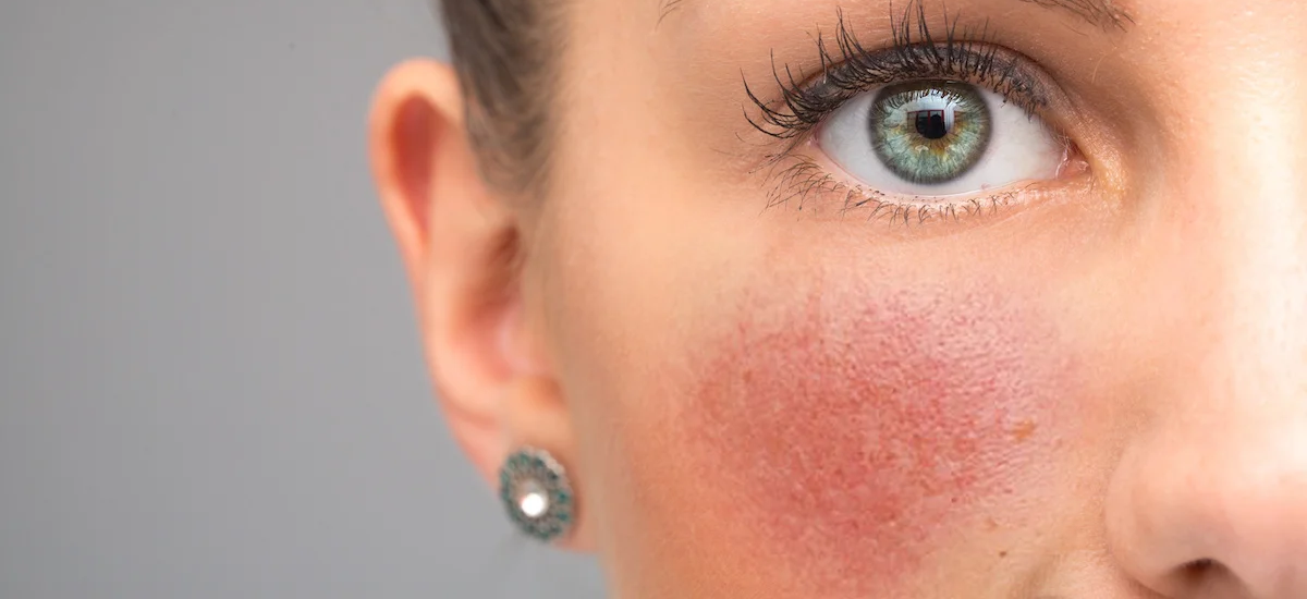 Rougeurs diffuses et couperose : rougeurs sur le visage