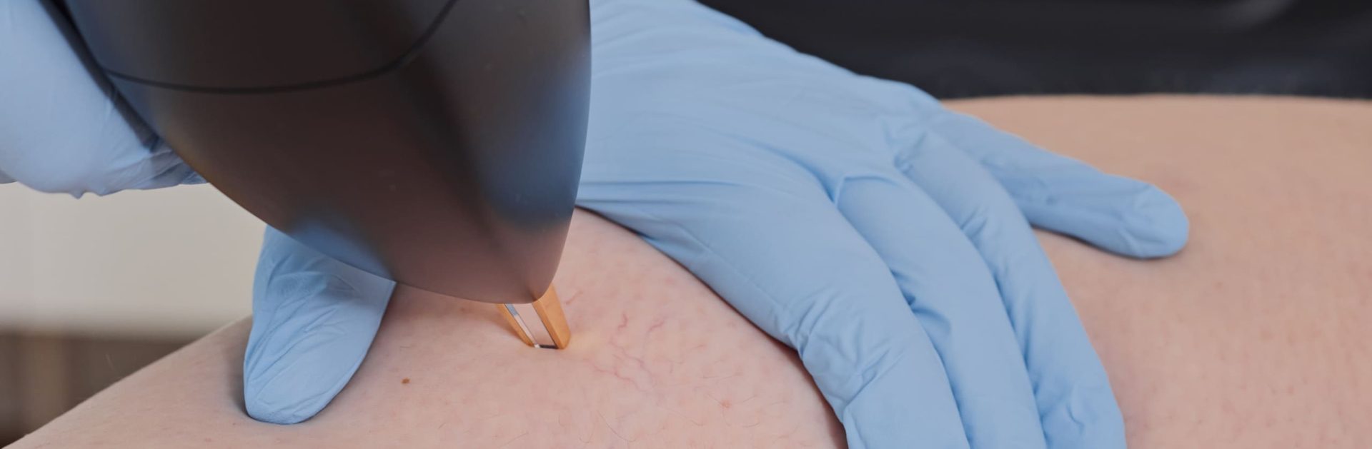 Vasculaze – Laser vasculaire