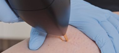 Vasculaze