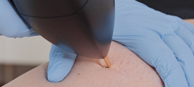 VIVA complète son offre avec le laser Vasculaze : une nouvelle solution ciblée pour traiter les varicosités