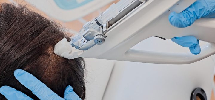 Exosomes ou PRP cheveux